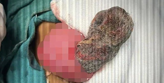 4 Yaşındaki Kızın Midesinden Şaşırtıcı Saç Yumağı Çıktı